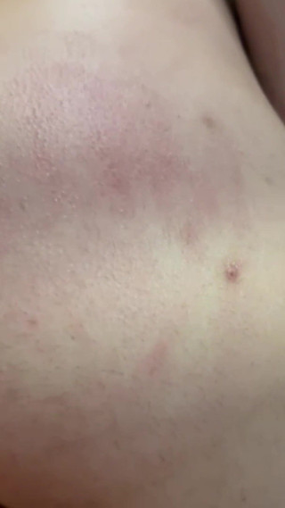 Not Blistered or Bruised yet