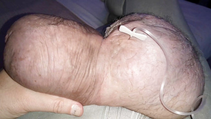 Two liters glucose inside my 1380cc silicone