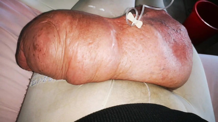 Another Huge Infussion