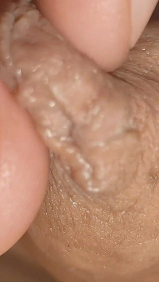 Large Healed Phimosis Holds the Cock Head.