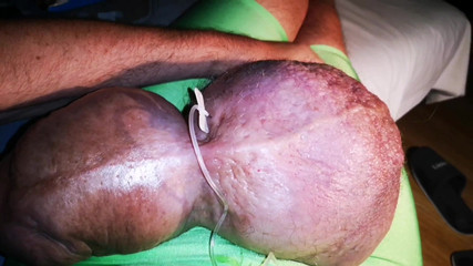 The 3th Liter Glucose